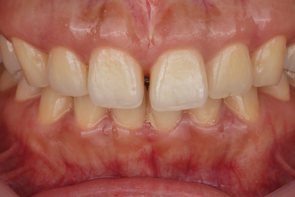 앞니 벌어짐을 레진 비니어로 당일 치료한 서초동 치과 관련 이미지 1