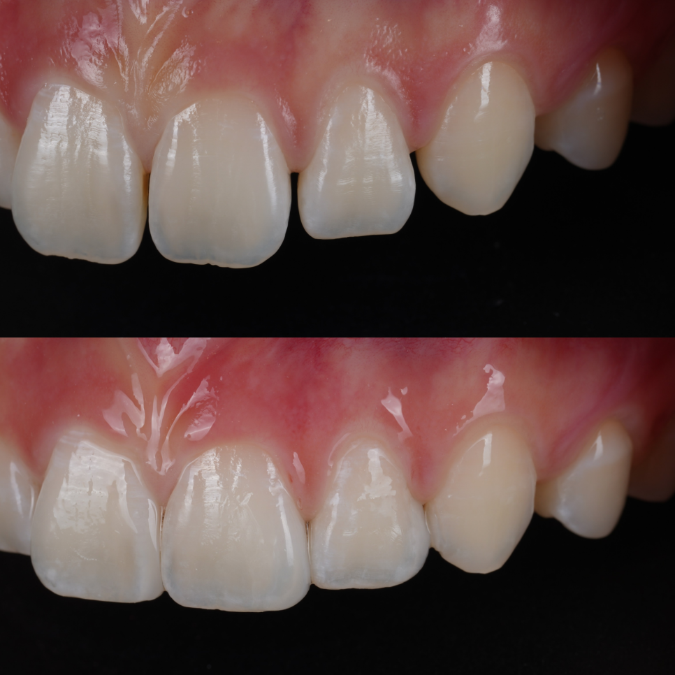 역삼역치과 벌어진 앞니 레진 이렇게 해야 진짜 티 안나요 관련 이미지 19