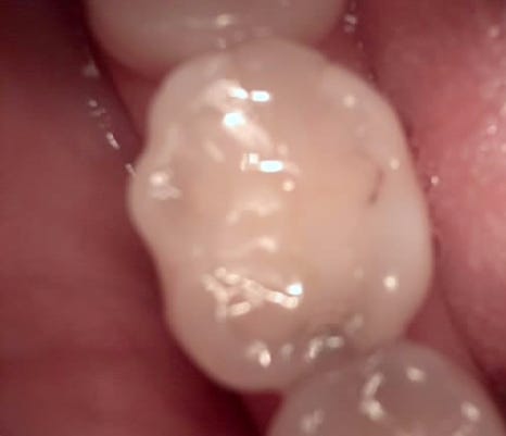 교대역 치과 보철 아래 2차 충치를 다시 레진으로 관련 이미지 21