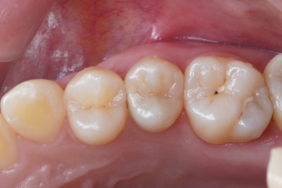 신경치료 할법한 어금니를 레진 빌드업으로 살려가는 이유 관련 이미지 4