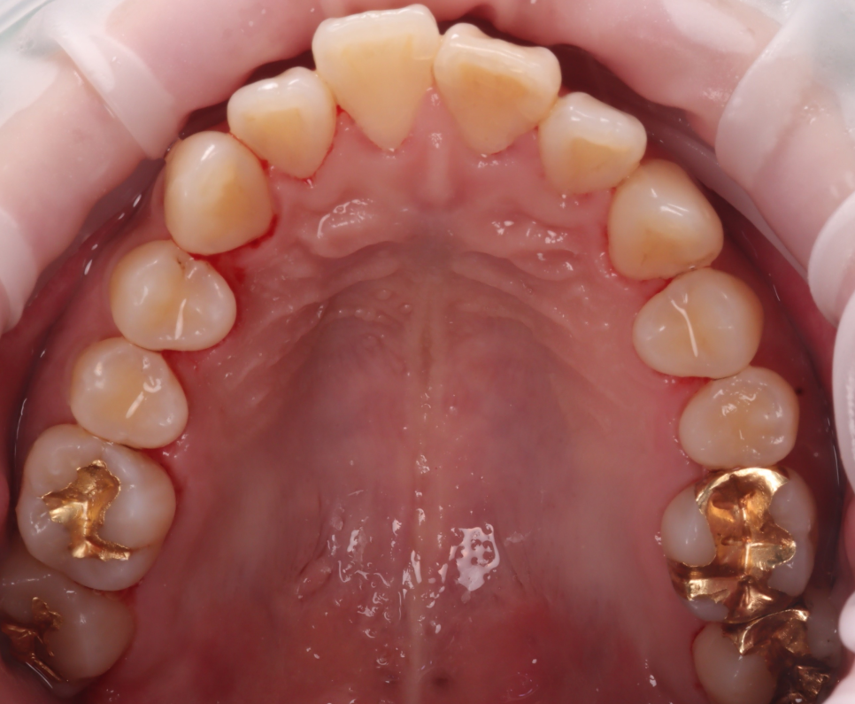 서초동치과 착색 고민되면 에어플로우 하세요 관련 이미지 8
