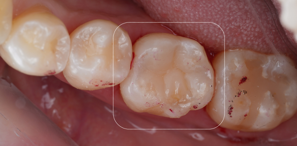 교대역 치과 보철 아래 2차 충치를 다시 레진으로 관련 이미지 27