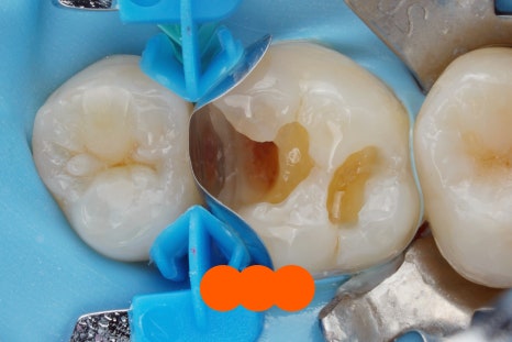 교대역 충치 치과, 신경치료 진단은 보수적으로 접근합니다. 관련 이미지 5