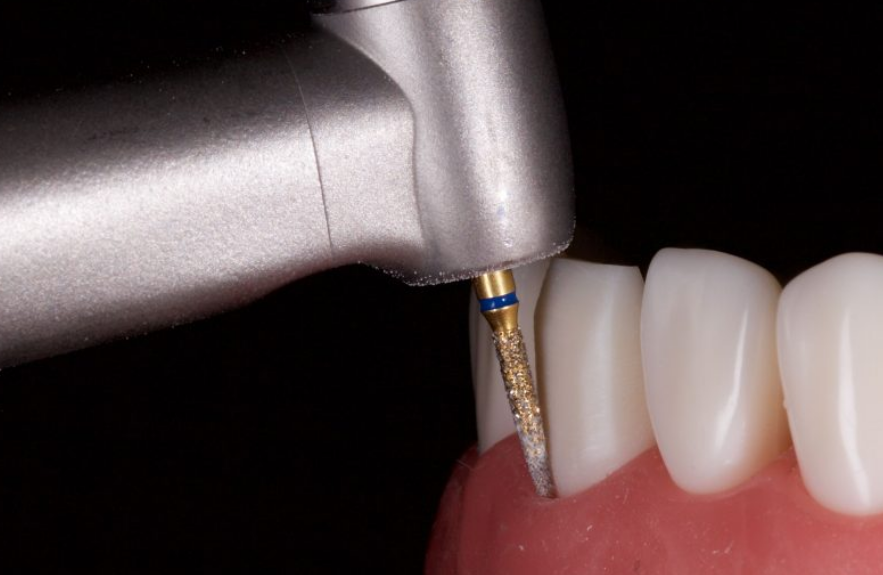 신논현역치과 심하게 마모된 60대 남성 앞니 크라운 치료 관련 이미지 6