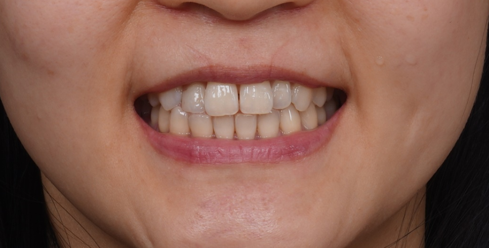 왜소치레진 20년 전에 했던 치아 재치료 후 반대쪽까지 관련 이미지 8