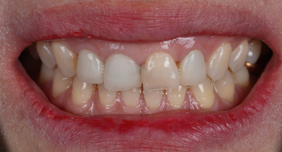 라미네이트, 크라운 재치료, 잇몸 성형까지 앞니 6개 치료 관련 이미지 5
