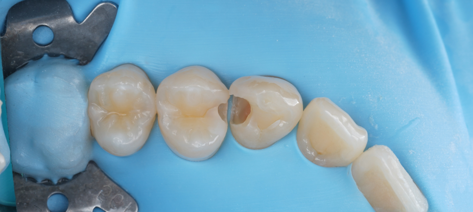 역삼역 치과 치대생 깊은 충치 신경치료없이 레진으로 완료 관련 이미지 12