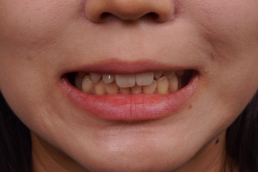 왜소치 레진 라미네이트, 당일 치료 완료! Direct composite veneer하는 서초동 치과 관련 이미지 2