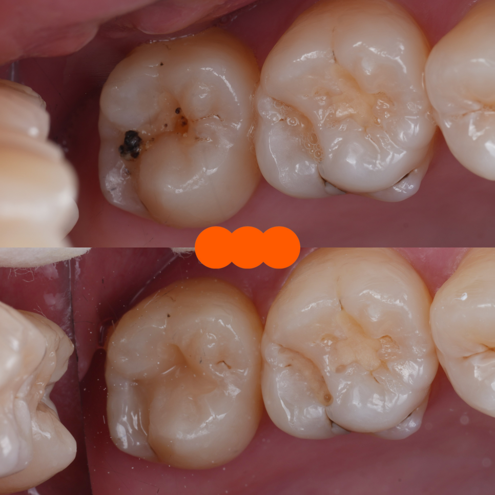 교대역치과 타치과 신경치료, 크라운 진단받았으나 레진으로 치료 관련 이미지 9