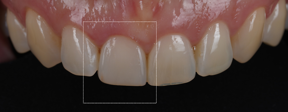 Gangnam Dental Clinic: Resin Restoration Process for a Chipped Front Tooth Considering Tooth Position image 9