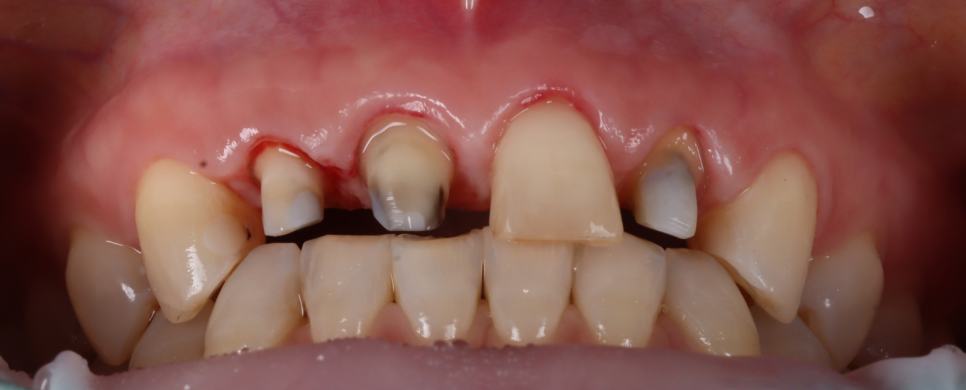라미네이트, 크라운 재치료, 잇몸 성형까지 앞니 6개 치료 관련 이미지 11