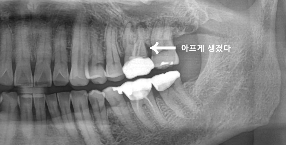 부모님(아버지) 어금니 재신경치료 해드린 썰 푼다.txt 관련 이미지 1