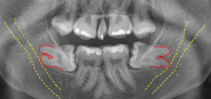 사랑니발치 매복 돼도 이렇게 빼면 안전해요 관련 이미지 6