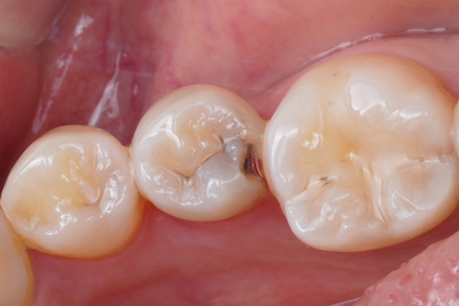신경치료 할법한 어금니를 레진 빌드업으로 살려가는 이유 관련 이미지 10