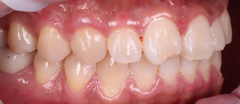 반포동치과 앞니 깨짐 레진 삭제 없이 당일에 치료 끝 관련 이미지 3