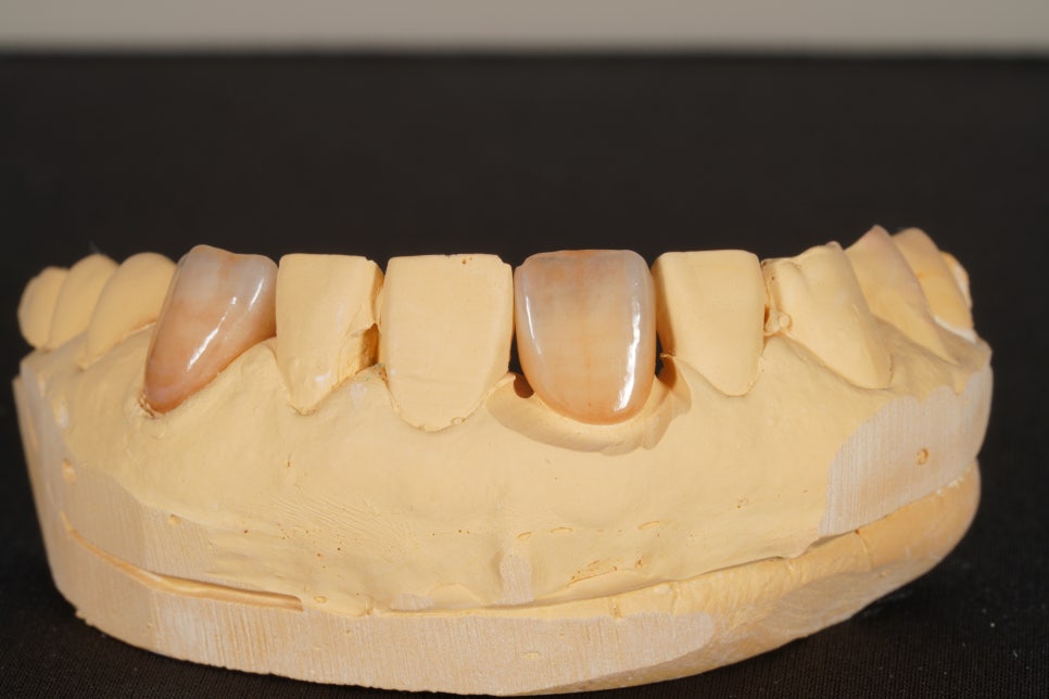 60년 전 신문배달할 때 다쳐서 씌운 앞니 크라운 변색, 지르코니아 재치료 관련 이미지 6