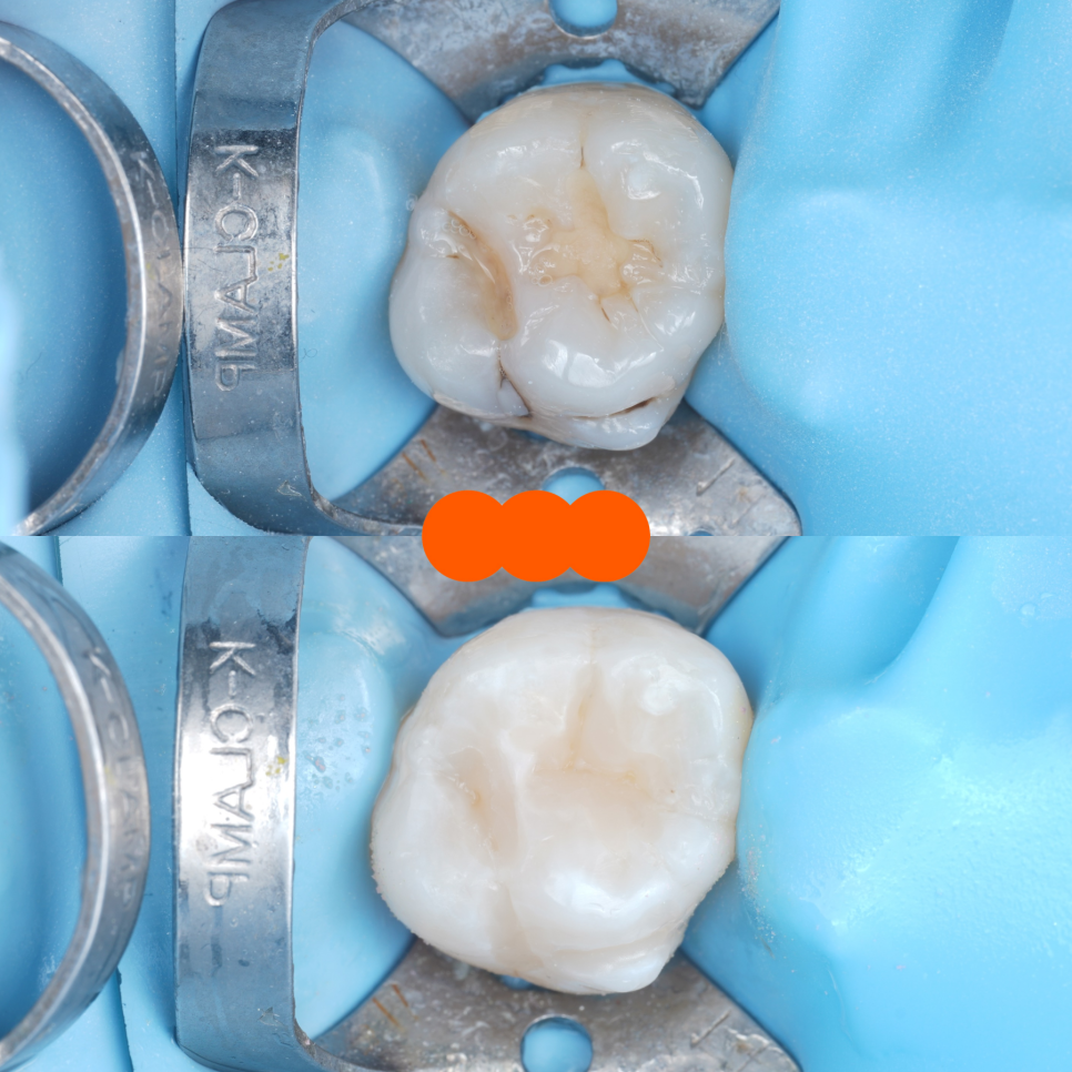 교대역치과 타치과 신경치료, 크라운 진단받았으나 레진으로 치료 관련 이미지 23