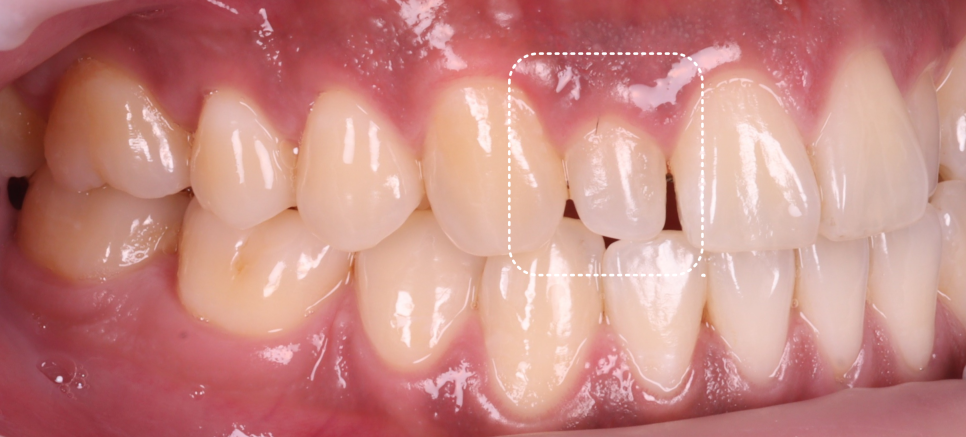 강남역치과 왜소치 레진 비니어로 삭제없이 가지런히 관련 이미지 3