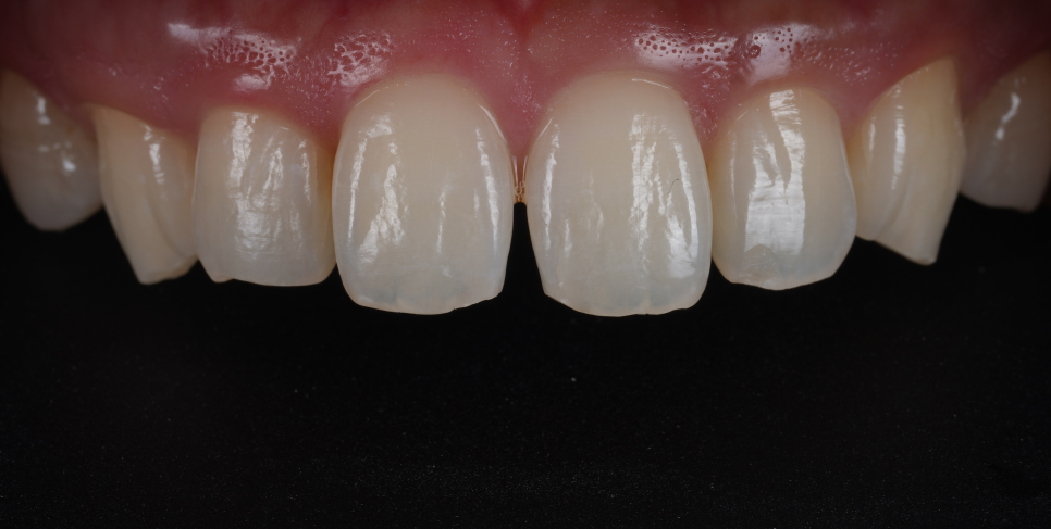 방배동치과 누렇고 벌어진 치아 미백과 레진 치료 관련 이미지 8