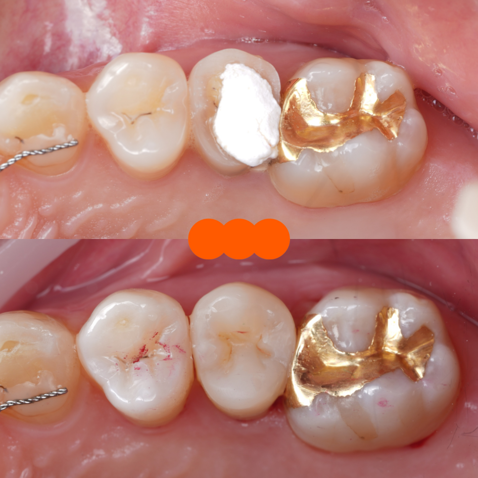 신경치료 후 크라운 안 하고 레진으로 할 수 있어요 관련 이미지 12