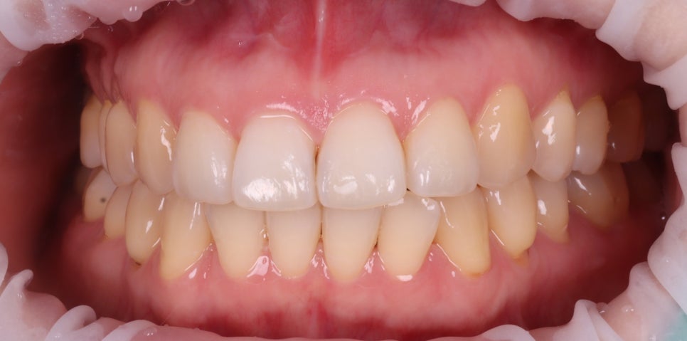 교대역 치과 보철 아래 2차 충치를 다시 레진으로 관련 이미지 2