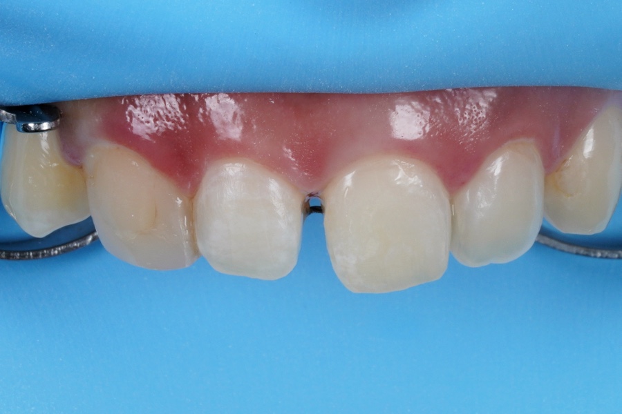 앞니 깨짐 레진 어디서할지 고민될 때 꼭 보세요 관련 이미지 10