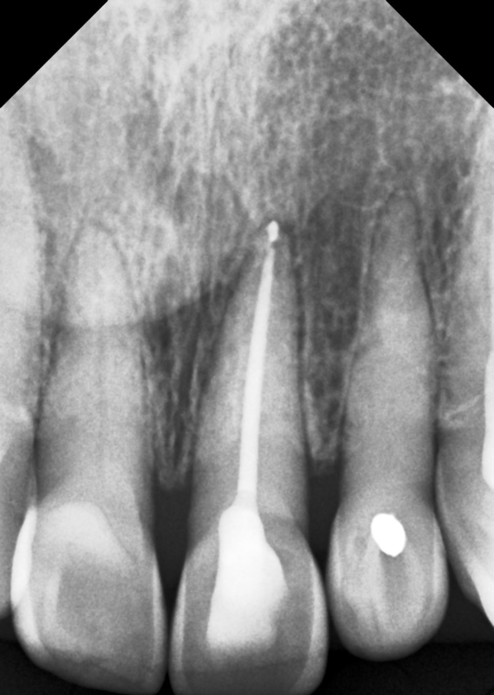 앞니 신경치료 변색 원인과 치료법인 실활치 미백 관련 이미지 2