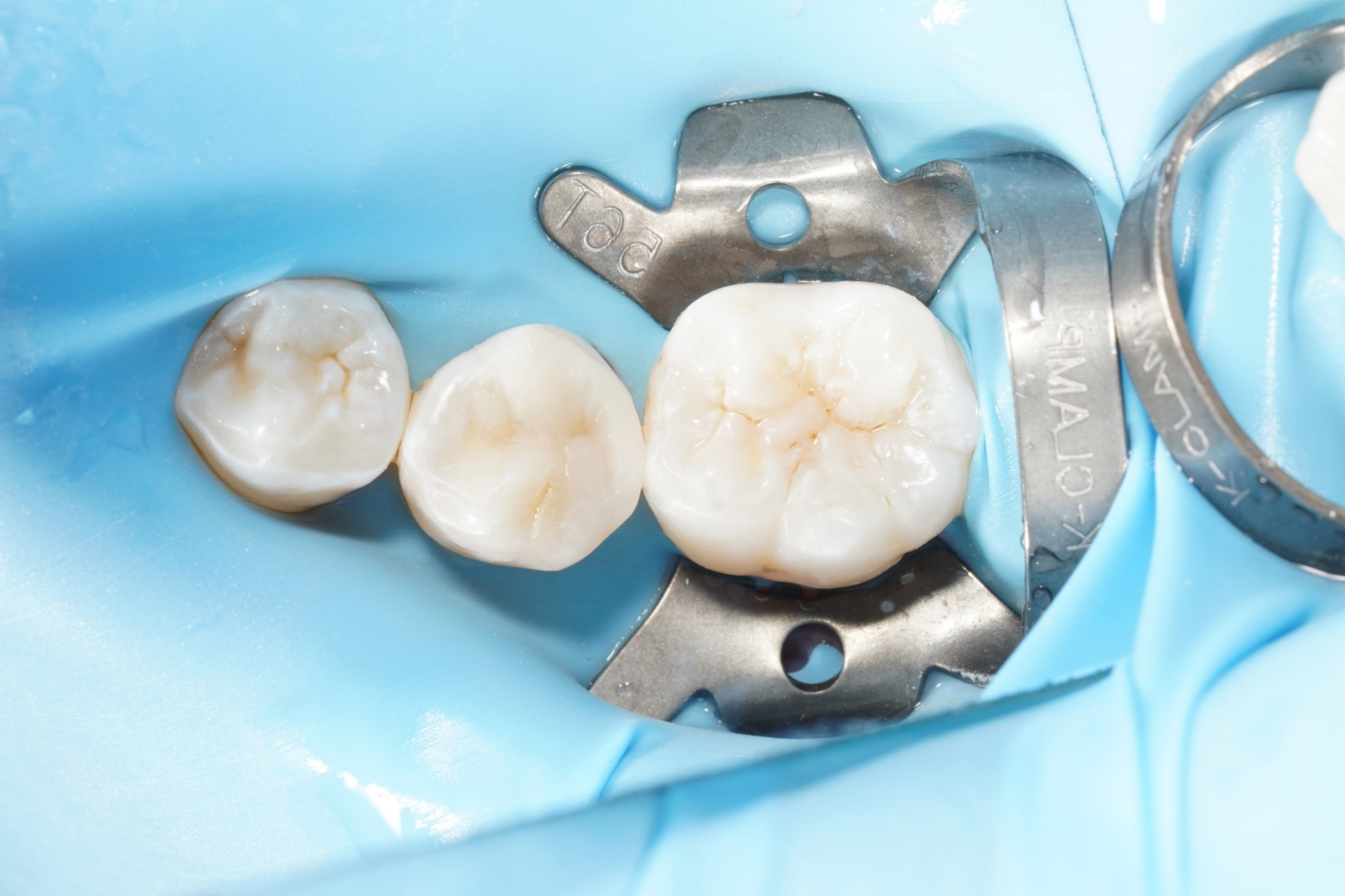 교대역 충치, 신경치료 회피하는 레진빌드업 치과이야기 관련 이미지 2