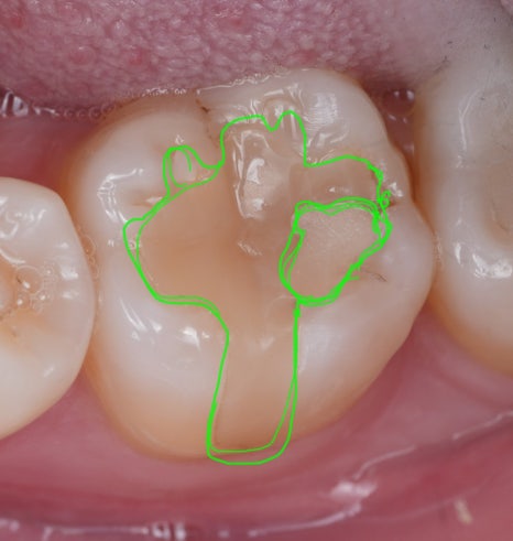 인레이치료 하방 2차 충치 레진 빌드업 사례 관련 이미지 3