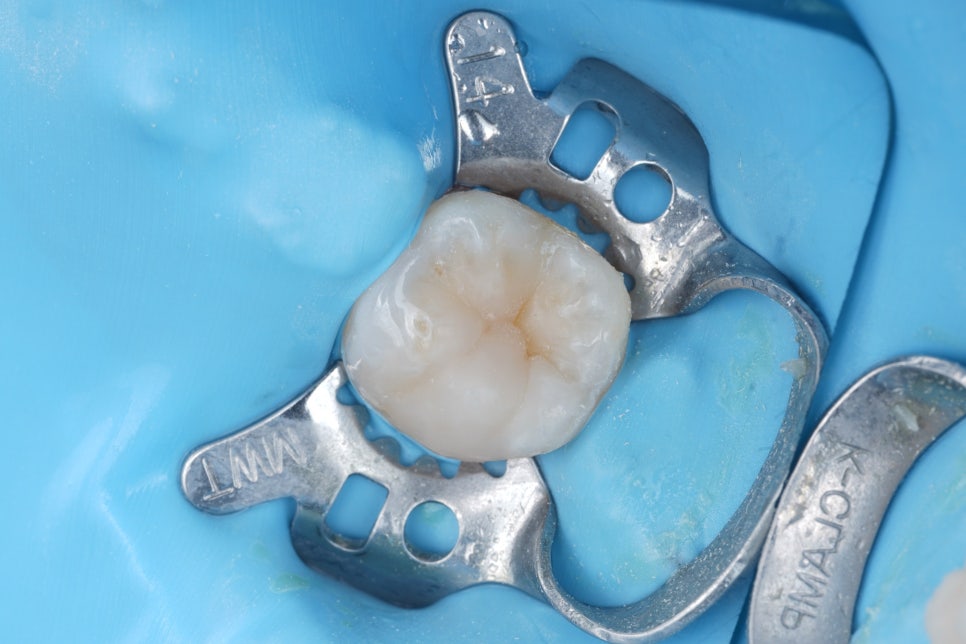 Jamnwon-dong Dental Clinic: Don’t Grind Down Your Teeth—Get Resin Build-up Instead image 9