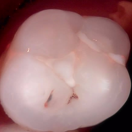 교대역 레진 실란트 밑에 깊은 2차충치 레진빌드업으로 당일 재치료 관련 이미지 3