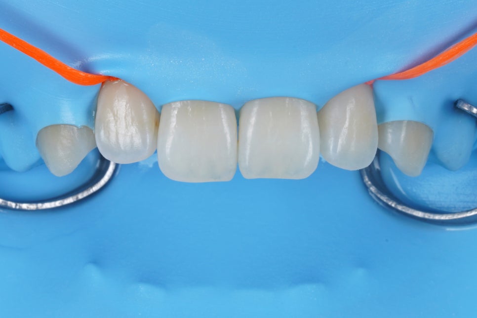 왜소치 라미네이트 대신 완전 무삭제로 1시간만에 치료 하세요 관련 이미지 3