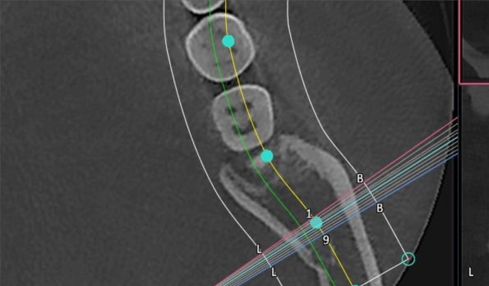 교대역 누운 매복 사랑니 당일 발치, 강남대성 별관에서 온 학생 관련 이미지 3
