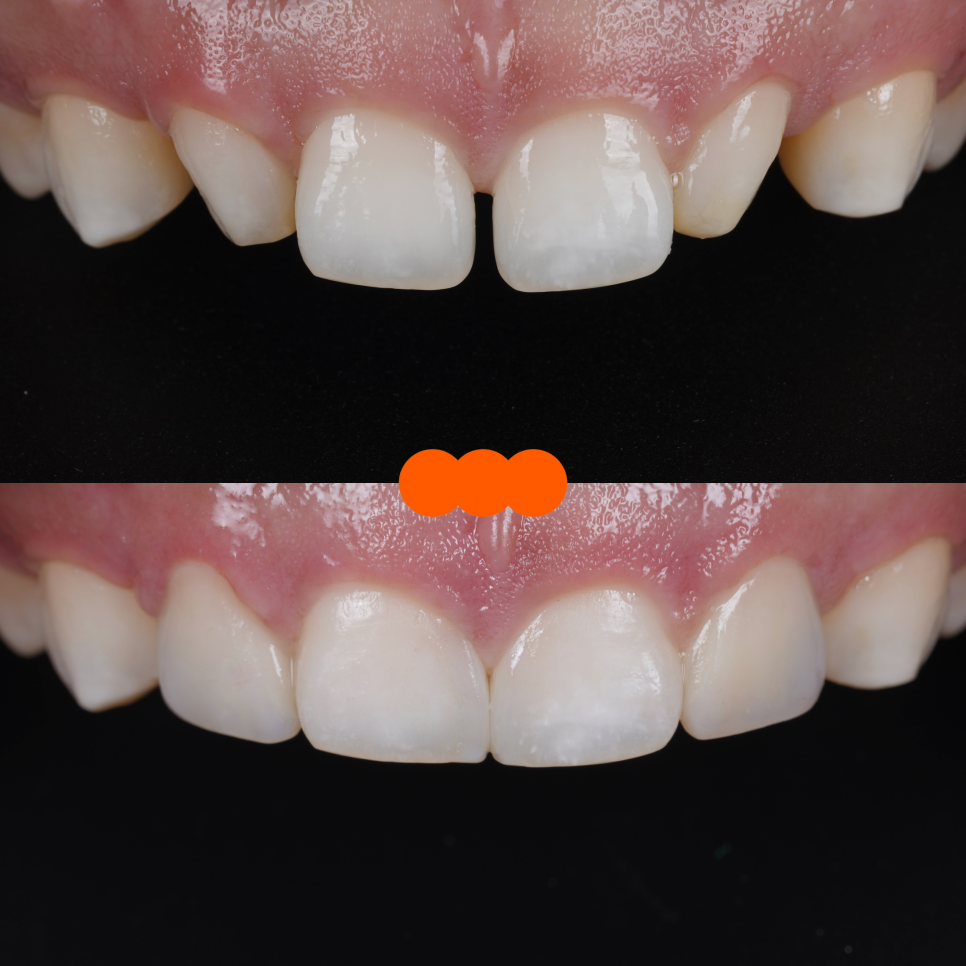 왜소치 라미네이트보다 레진 비니어를 더 추천드리는 이유 관련 이미지 4