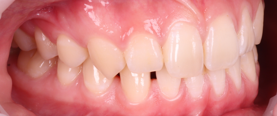 역삼역치과 벌어진 앞니 레진 이렇게 해야 진짜 티 안나요 관련 이미지 7