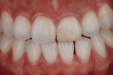 앞니 신경치료 변색 원인과 치료법인 실활치 미백 관련 이미지 8