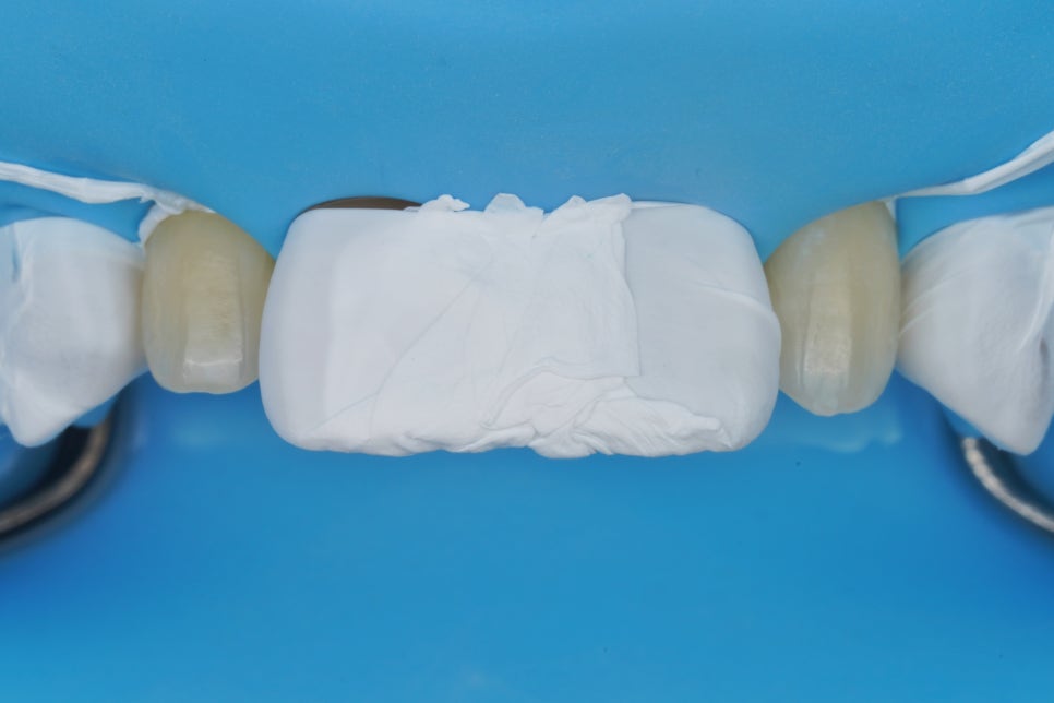 왜소치 레진, 갤럭시네이트 레진비니어로 당일 치료완료 (서초동 치과) 관련 이미지 7