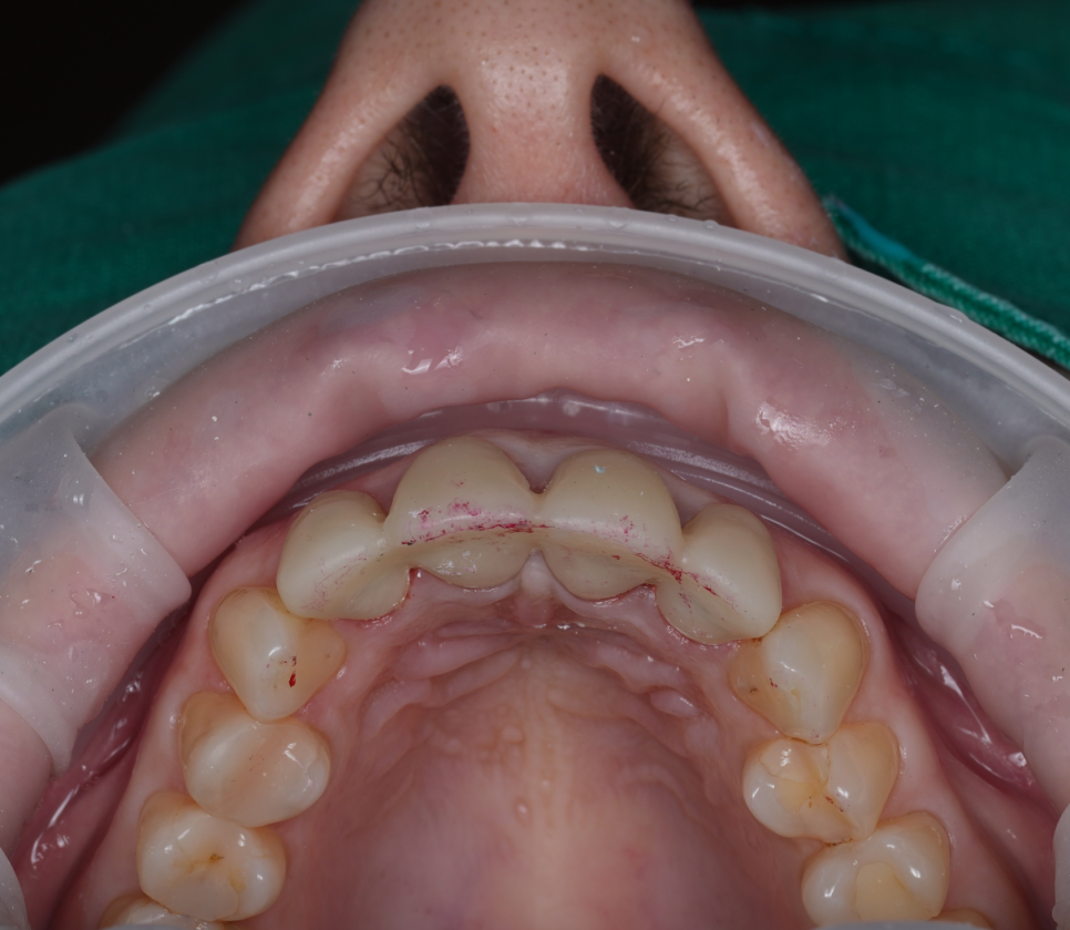 신논현치과 외국인 까만 앞니 크라운 교체 사례 관련 이미지 10