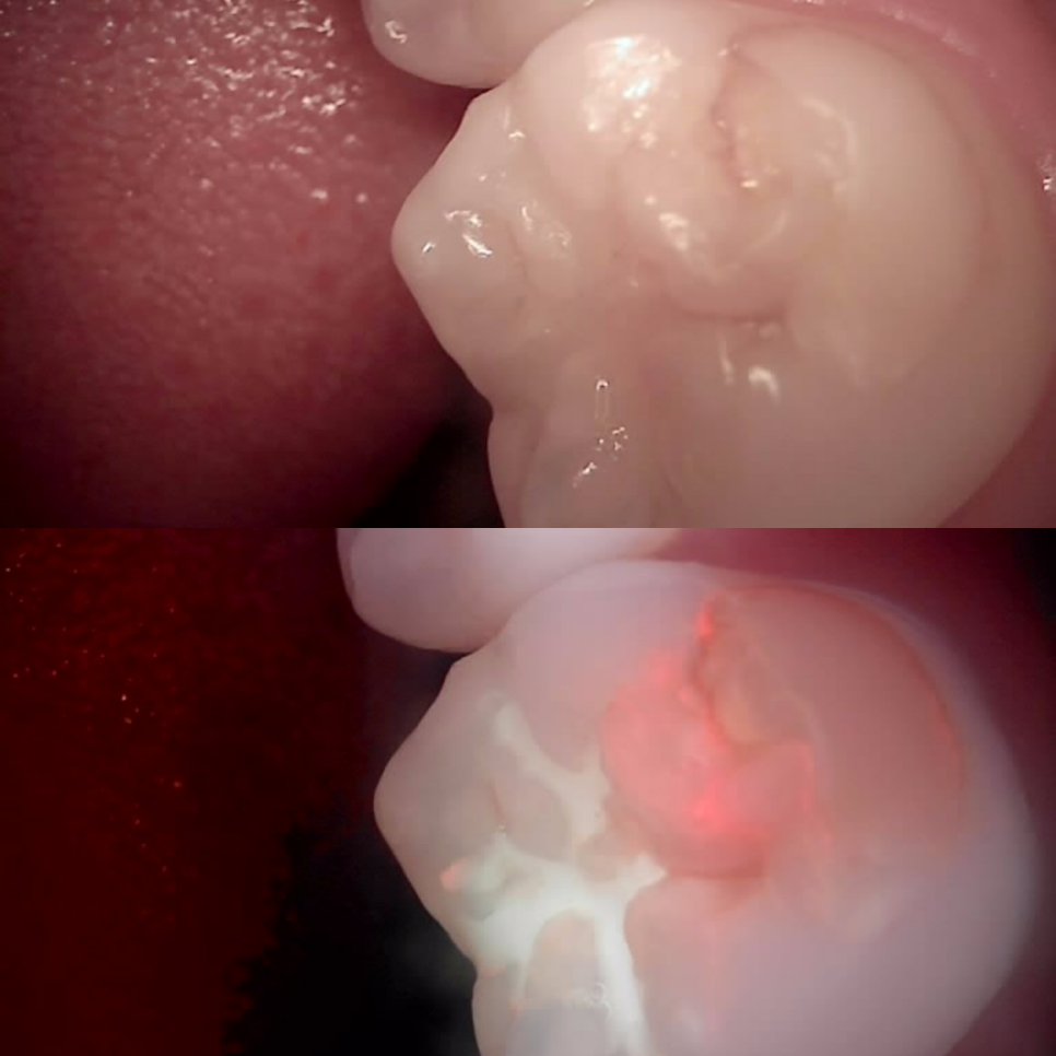 Jamnwon-dong Dental Clinic: Don’t Grind Down Your Teeth—Get Resin Build-up Instead image 4