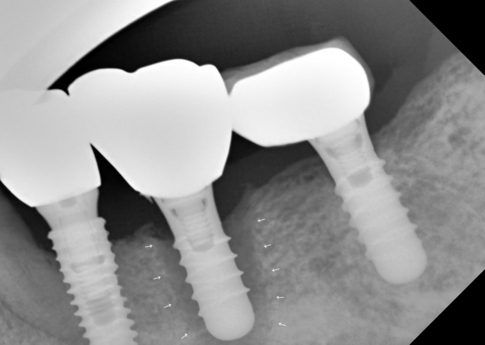잇몸뼈 녹음, 뼈이식으로 부족한 잇몸 강화 후 기다리는 이유 관련 이미지 1