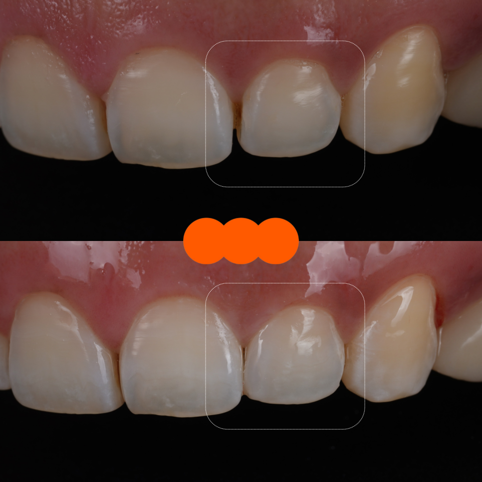 서초구치과 치아 사이 삭제 부작용과 치료법 관련 이미지 15
