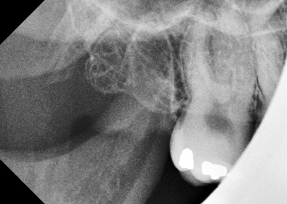 사랑니발치 매복 돼도 이렇게 빼면 안전해요 관련 이미지 12