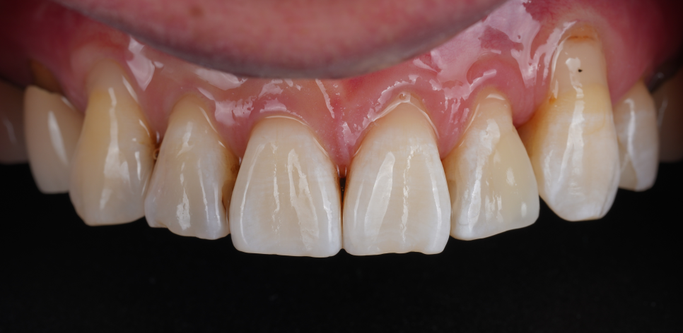 서초구치과 레진 탈락 재치료 2가지가 성공 핵심입니다 관련 이미지 9