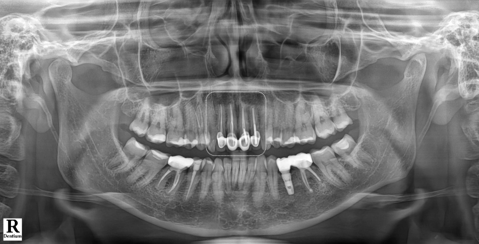 신논현치과 외국인 까만 앞니 크라운 교체 사례 관련 이미지 5