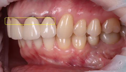 신논현치과 외국인 까만 앞니 크라운 교체 사례 관련 이미지 7