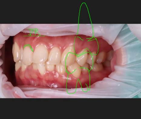 왜소치 레진으로 삭제 없이 예쁘게 관련 이미지 10