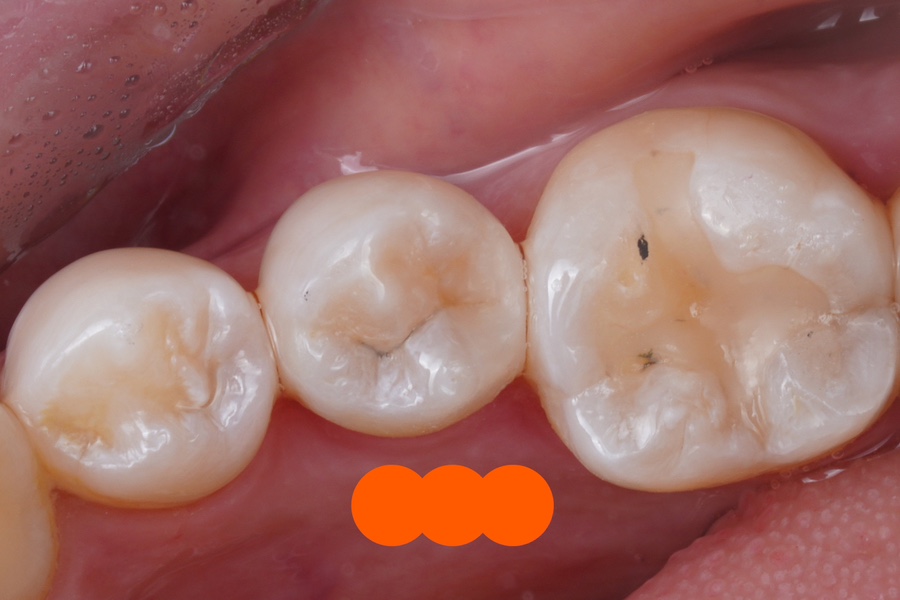 신경치료 할법한 어금니를 레진 빌드업으로 살려가는 이유 관련 이미지 12