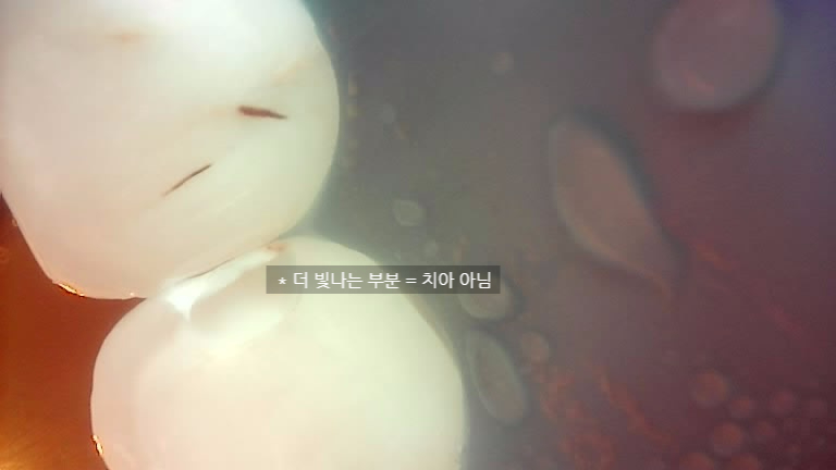 교대역, 교정 끝나고 앞니 사이 충치 레진 재치료 (유지장치 붙이기 전에 오세요) 관련 이미지 4