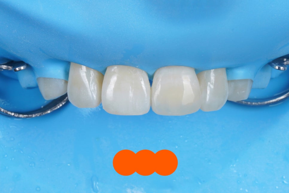 서울 앞니 레진으로 40분 안에 자연스럽게 복원한 케이스 관련 이미지 8