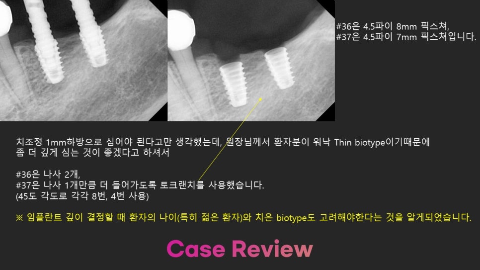 야, 너두 임플란트 할 수 있어 <책> 김영삼 원장의 임플란트 달인되기 관련 이미지 3